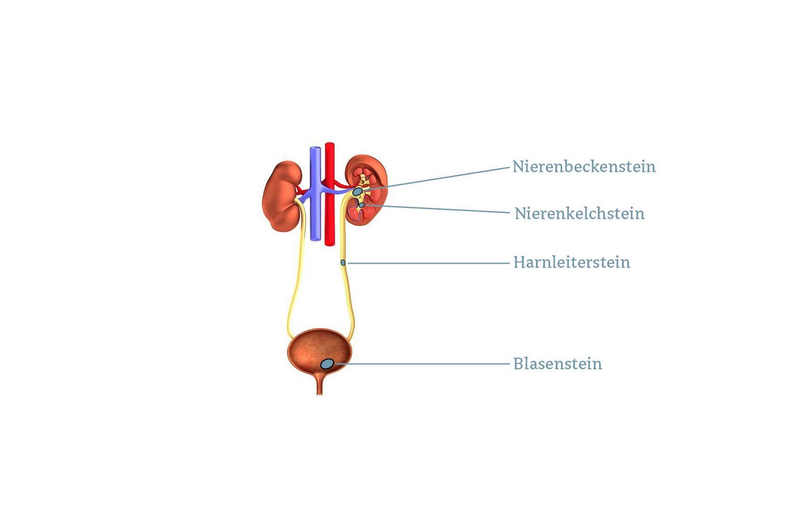 Nieren- und Harnleitersteine werden ja nach Lage und Größe mit unterschiedlichen Therapieoptionen behandelt.